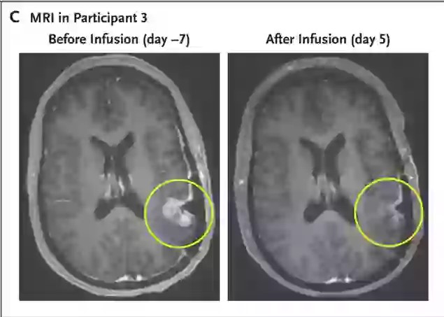 Čudo u borbi protiv raka: Tumor u mozgu žene gotovo nestao za samo 5 dana!