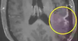Čudo u borbi protiv raka: Tumor u mozgu žene gotovo nestao za samo 5 dana!