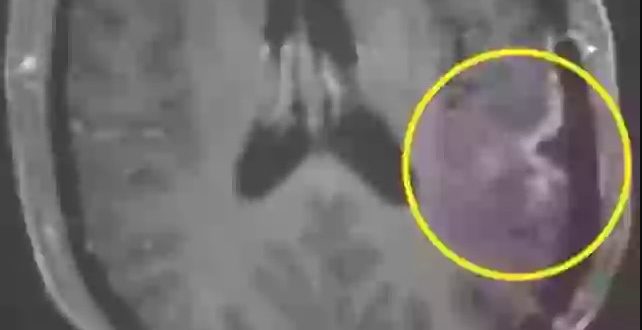 Čudo u borbi protiv raka: Tumor u mozgu žene gotovo nestao za samo 5 dana!