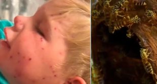 Dvogodišnje dijete u kritičnom stanju nakon što ga je napao roj osa: Otkazali mu vitalni organi