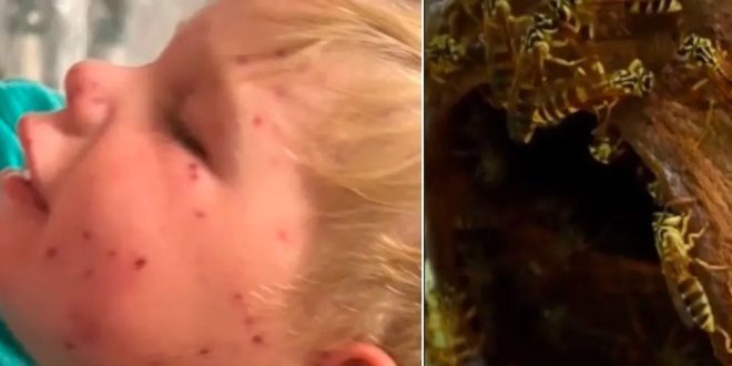 Dvogodišnje dijete u kritičnom stanju nakon što ga je napao roj osa: Otkazali mu vitalni organi