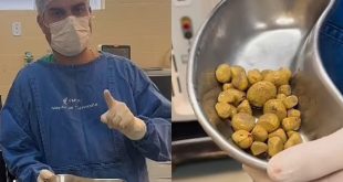 Muškarac koji je pio tri litra Coca-Cole dnevno završio s 35 kamenaca u bešici