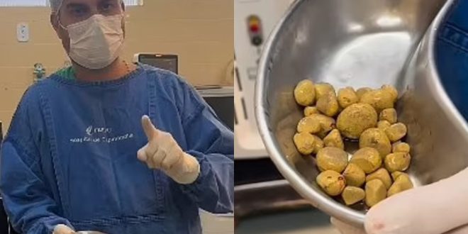 Muškarac koji je pio tri litra Coca-Cole dnevno završio s 35 kamenaca u bešici